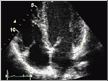 Digital Echocardiography