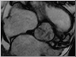 MRI